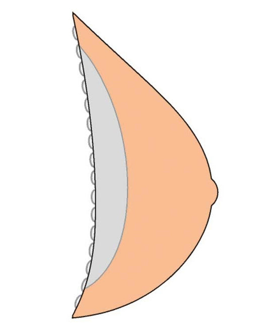 Contact 3E 386CT Breast Form - Tawny