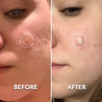 Pimple Patches With Hydrocolloid
